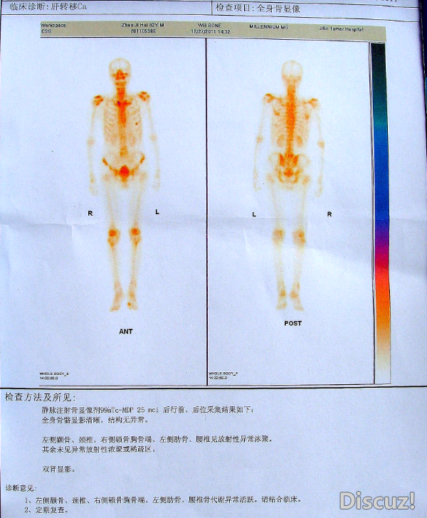骨扫描诊断